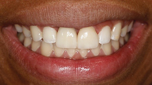 Closeup of smile after dental implant supported tooth replacement