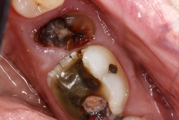 infected tooth