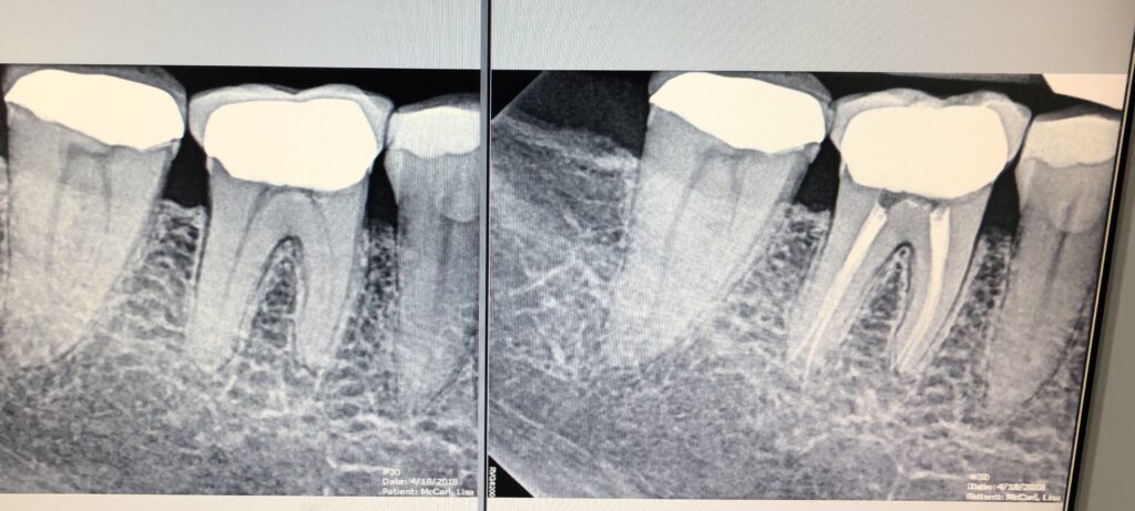 image of root canal before and after